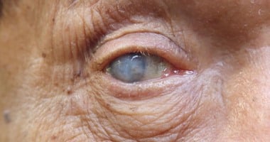 عملية ازالةدكتور عيون تخصص مياه زرقاء الماء الابيض من العين