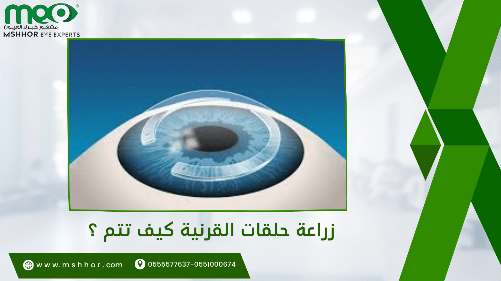 زراعة حلقات القرنية كيف تتم ؟