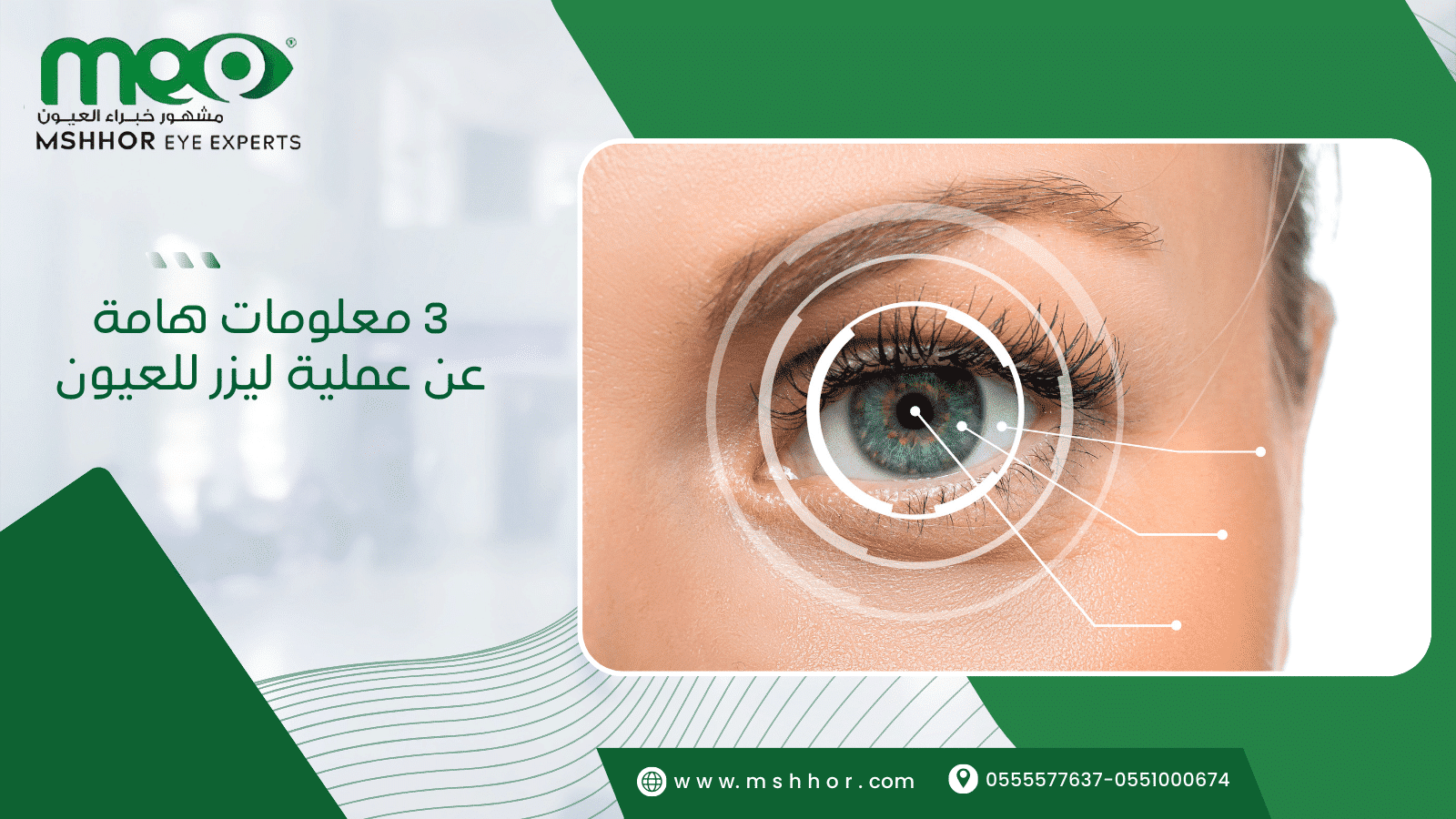 3 معلومات هامة عن عملية ليزر للعيون