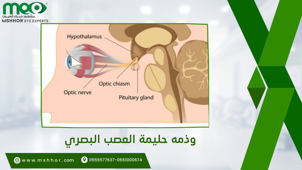 وذمه حليمة العصب البصري وأسبابها