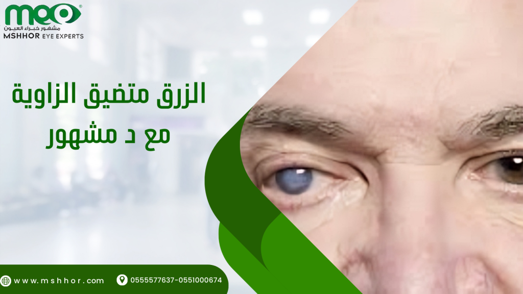 الزرق متضيق الزاوية مع د مشهور