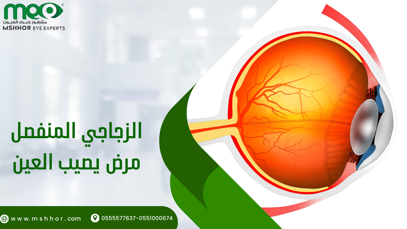 الزجاجي المنفصل مرض يصيب العين