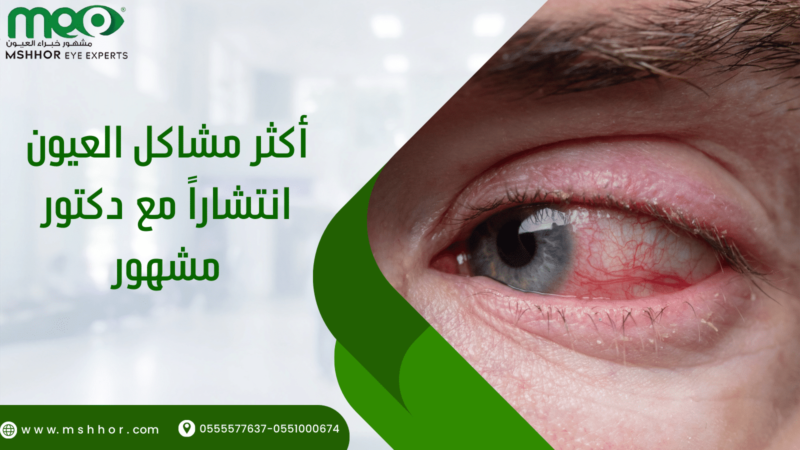 أكثر مشاكل العيون انتشاراً مع دكتور مشهور