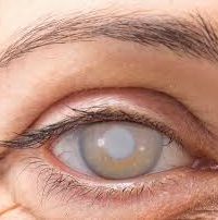 اعراض المياه الزرقاء والبيضاء في العين