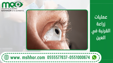 عمليات زراعة القرنية في العين