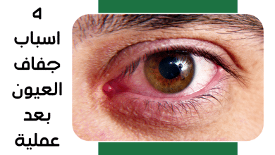 4 اسباب جفاف العيون بعد عملية الليزك