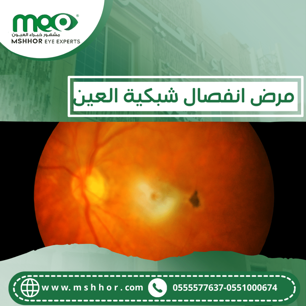 مرض انفصال شبكية العين