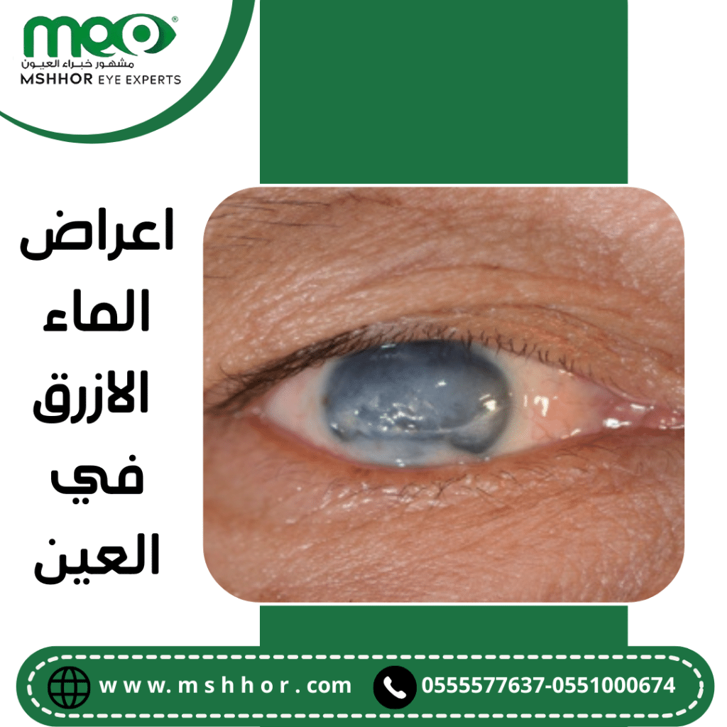 اعراض الماء الازرق في العين (الجلوكوما)