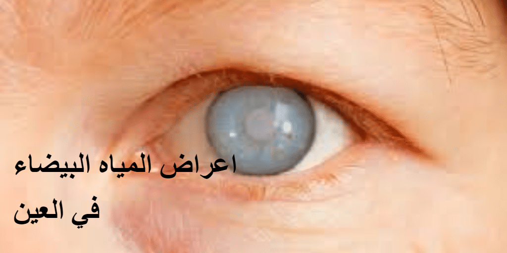 أعراض المياه البيضاء في العين
