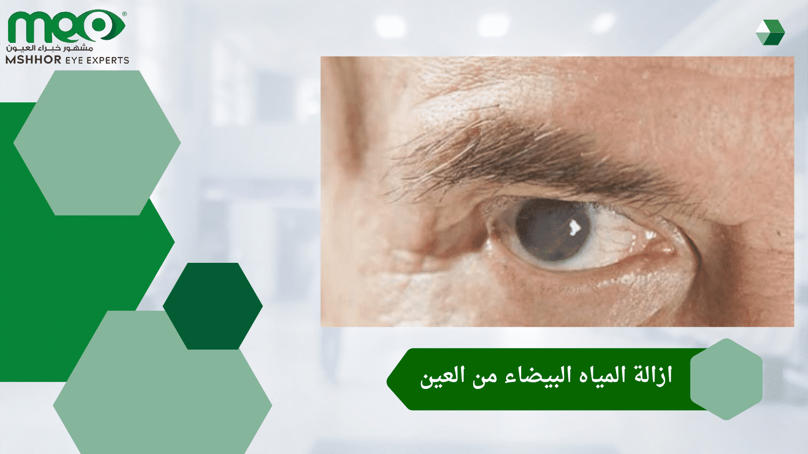 ازالة المياه البيضاء من العين