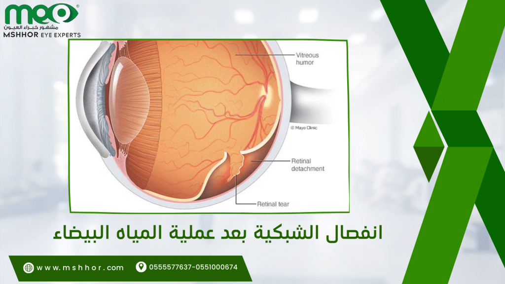 انفصال الشبكية بعد عملية المياه البيضاء