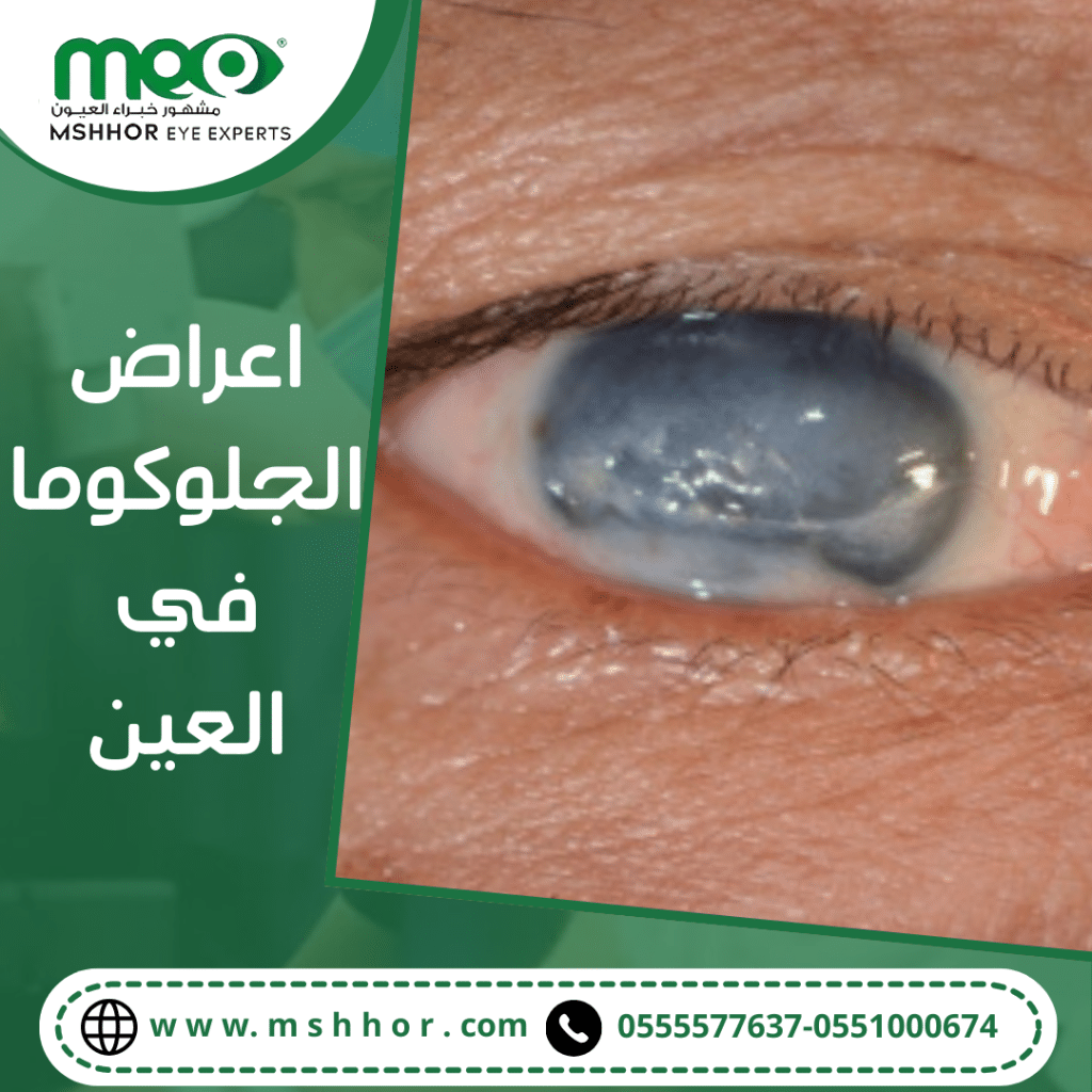 اعراض الجلوكوما في العين