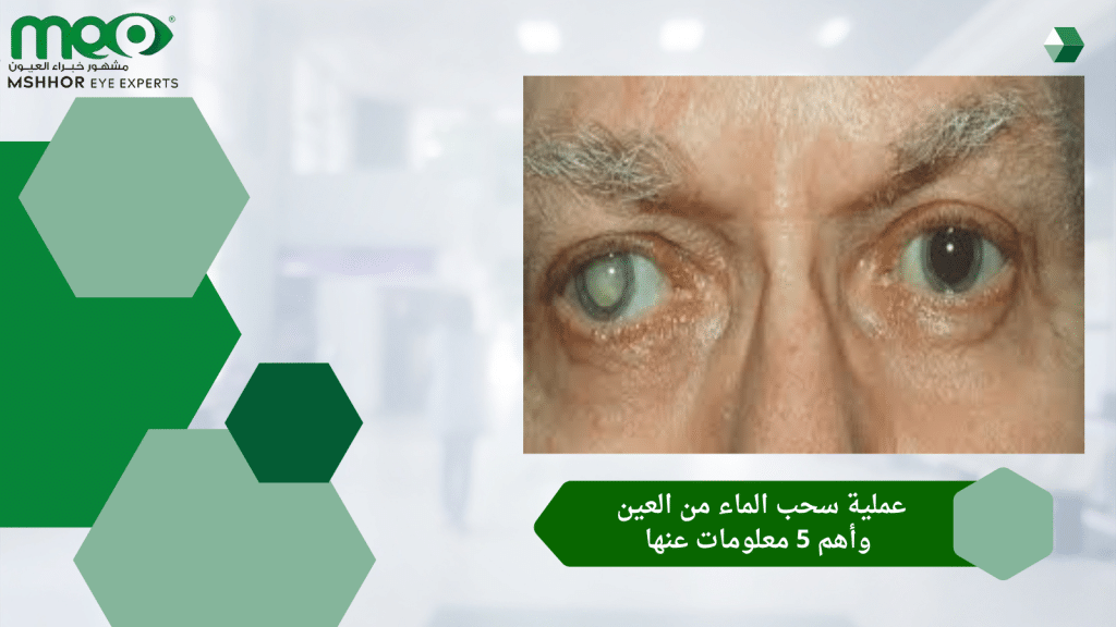 عملية سحب الماء من العين وأهم 5 معلومات عنها