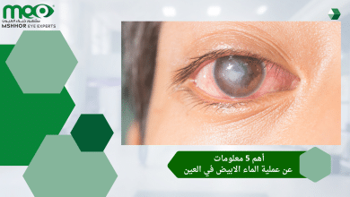أهم 5 معلومات عن عملية الماء الابيض في العين