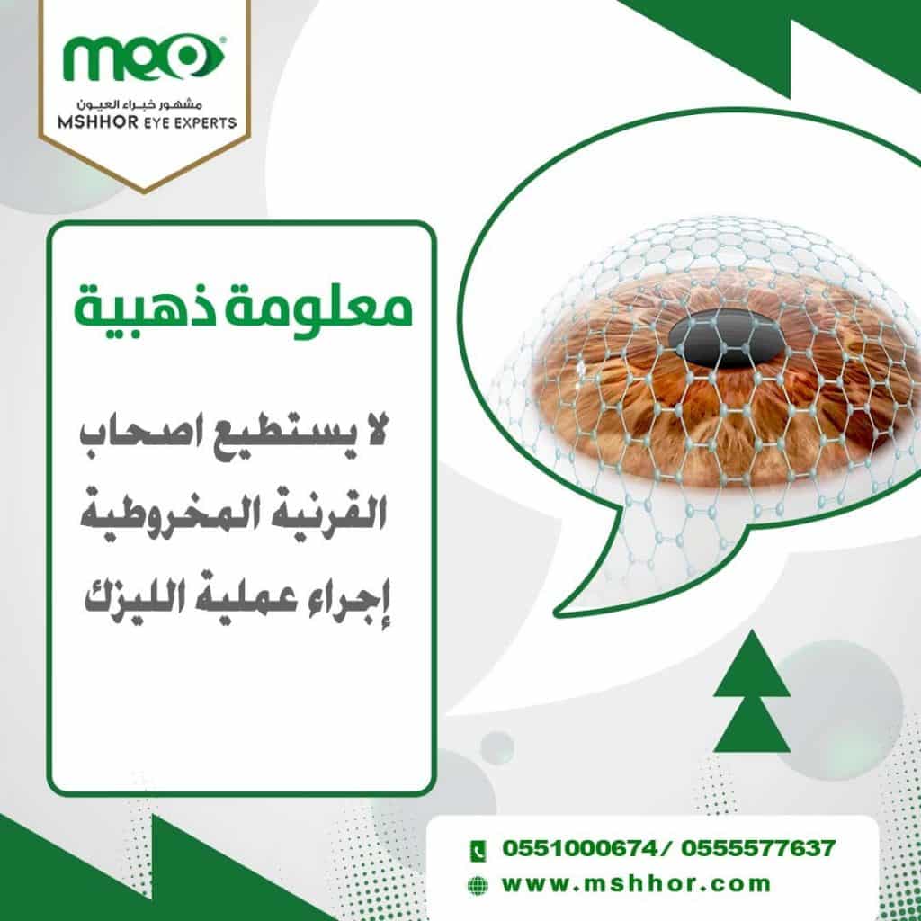 5 علامات فشل عملية الليزك - مركز مشهور خبراء العيون