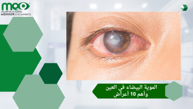 الموية البيضاء في العين وأهم 10 أعراض