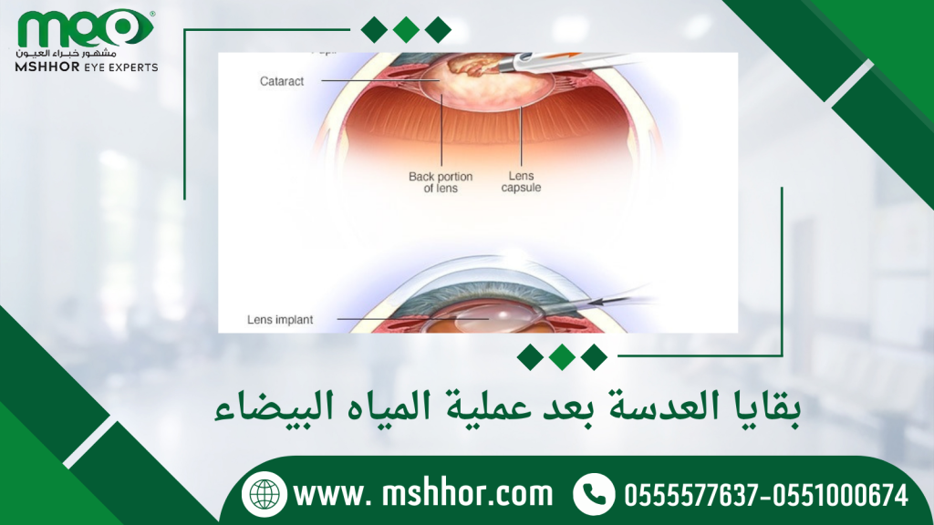 بقايا العدسة بعد عملية المياه البيضاء