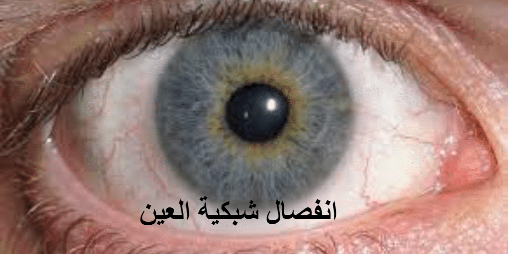انفصال شبكية العين