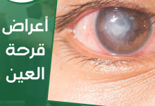 أعراض قرحة العين