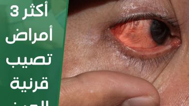 أكثر 3 أمراض تصيب قرنية العين