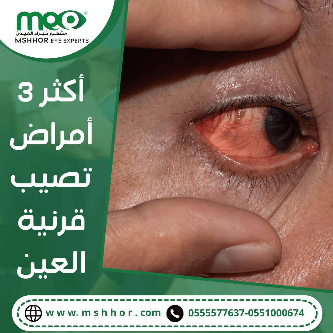 أكثر 3 أمراض تصيب قرنية العين