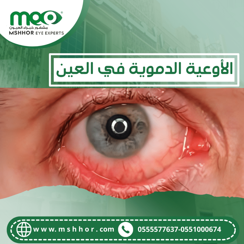 الأوعية الدموية في العين
