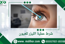 شرط عملية الليزر للعيون