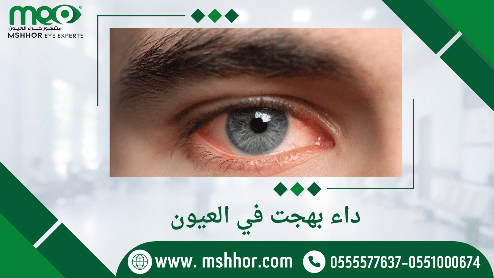 داء بهجت في العيون