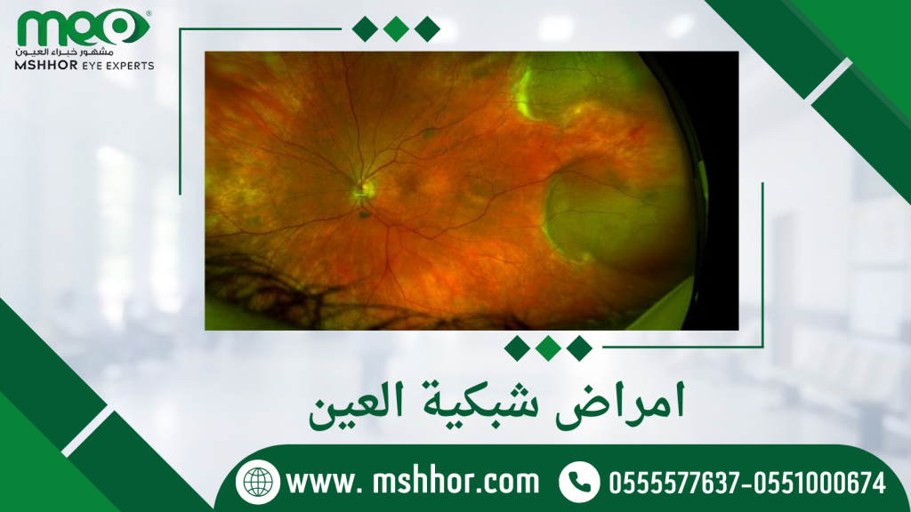 امراض شبكية العين