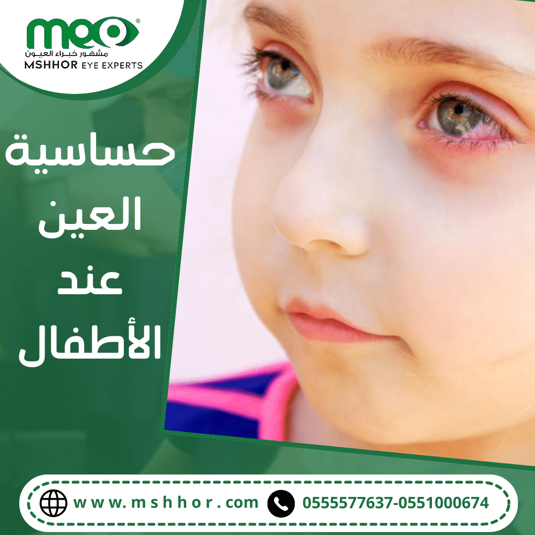 حساسية العين عند الأطفال