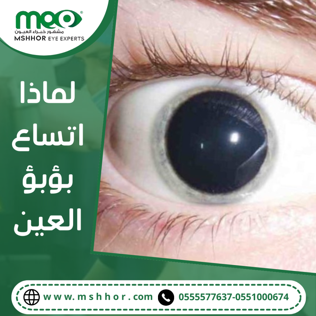 لماذا اتساع بؤبؤ العين