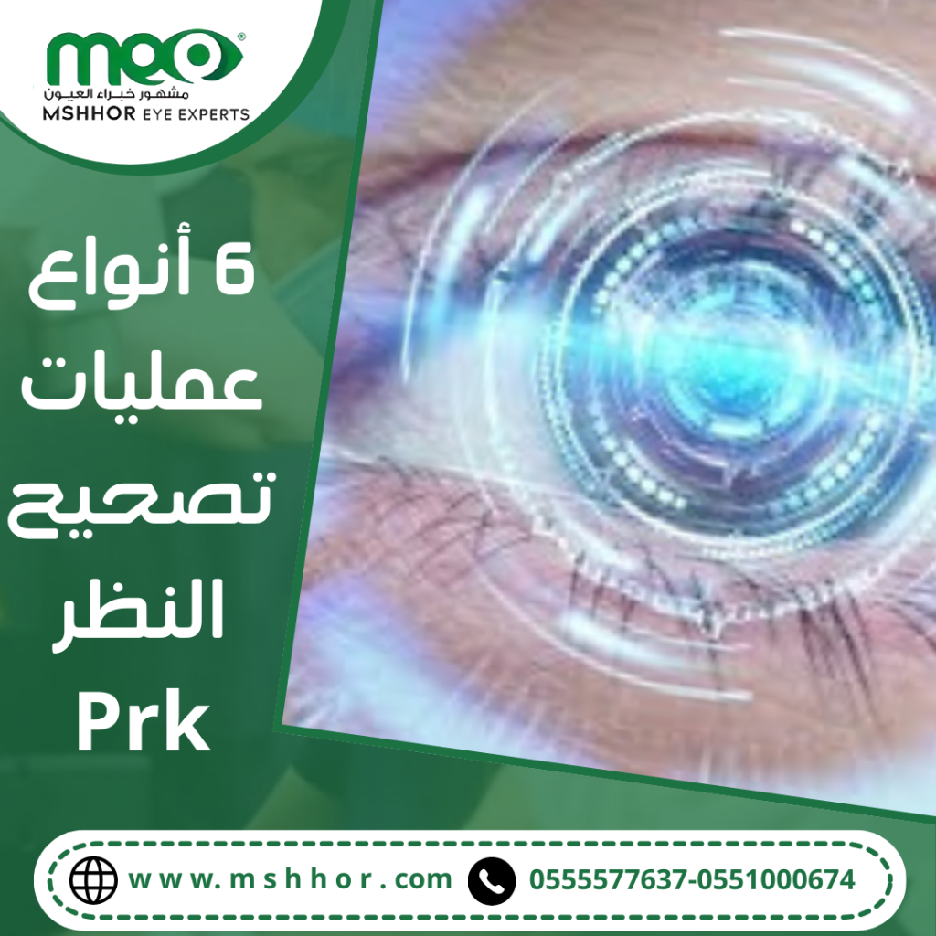 6 أنواع عمليات تصحيح النظر Prk