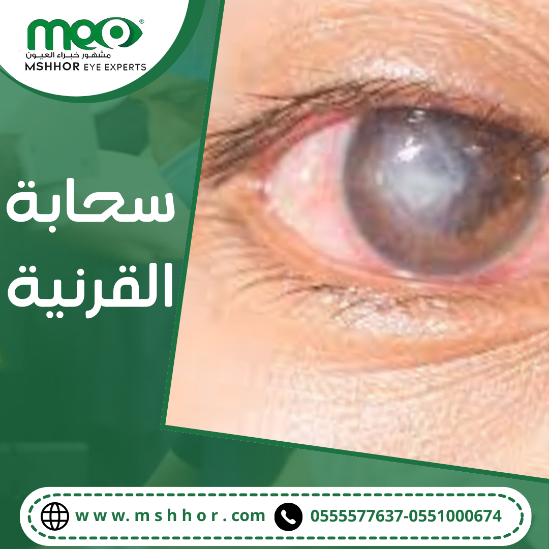 سحابة القرنية