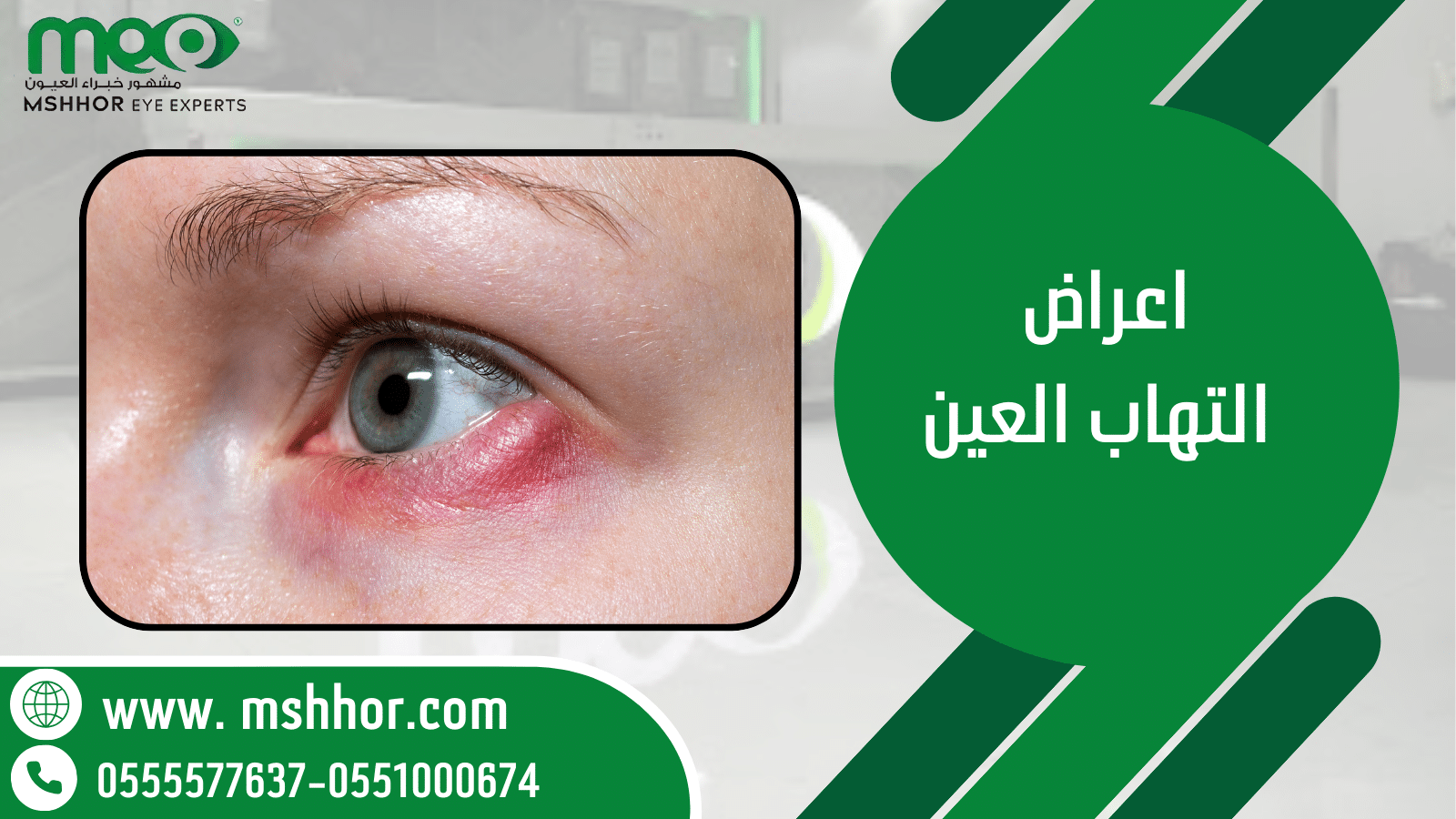 اعراض التهاب العين