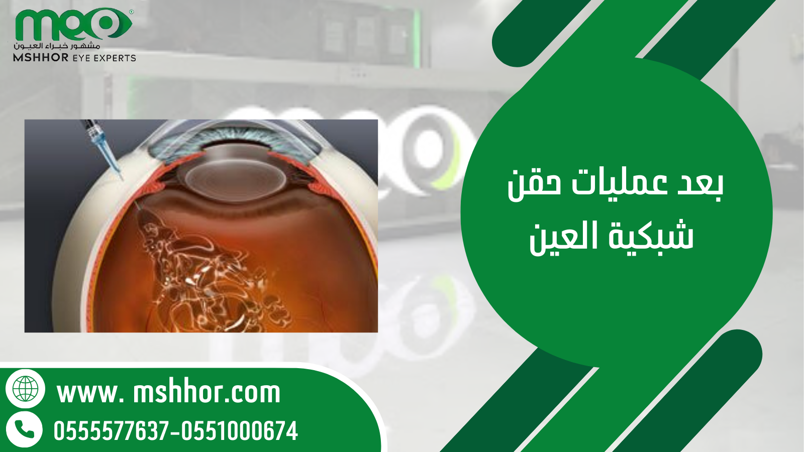 بعد عمليات حقن شبكية العين