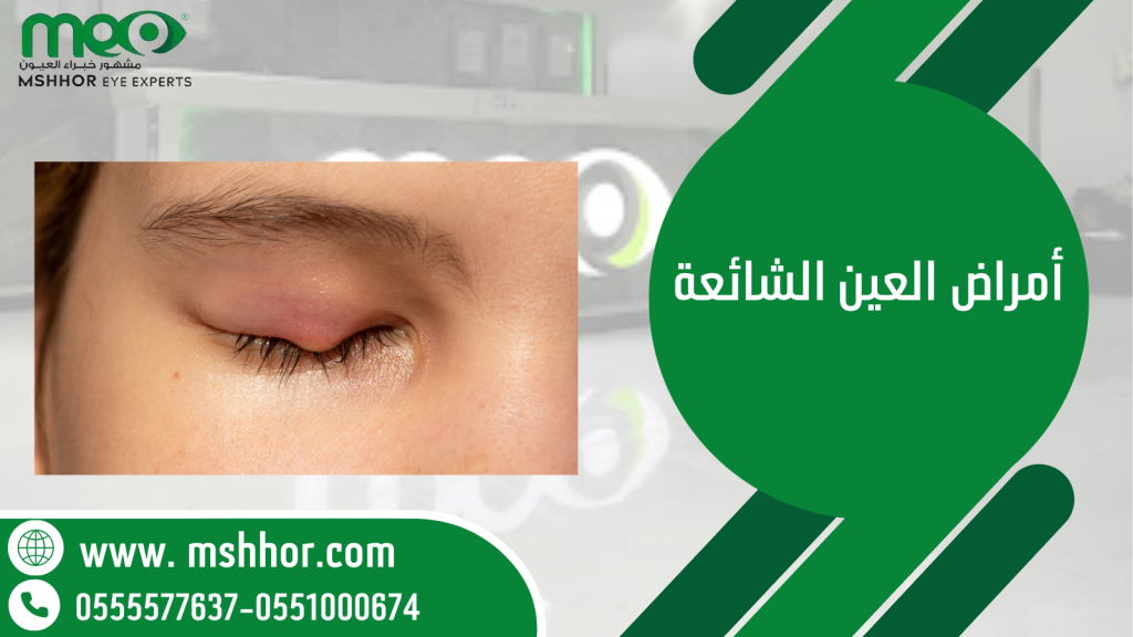 أمراض العين الشائعة