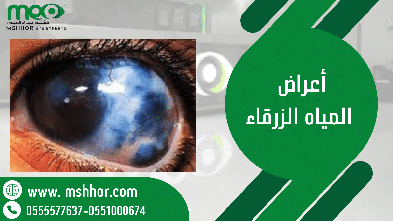 أعراض المياه الزرقاء