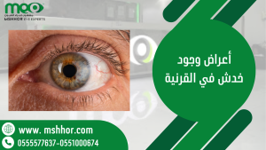 مدة شفاء خدش القرنية ومتى يعود النظر طبيعيًا