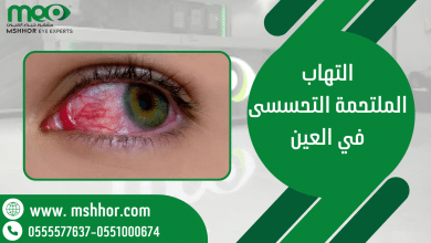 التهاب الملتحمة التحسسى في العين