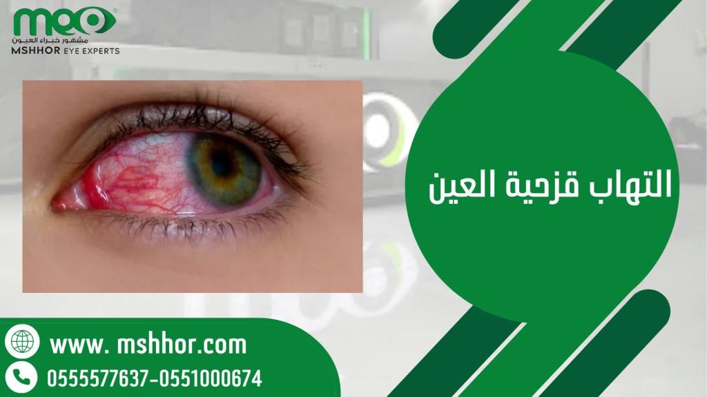 التهاب قزحية العين