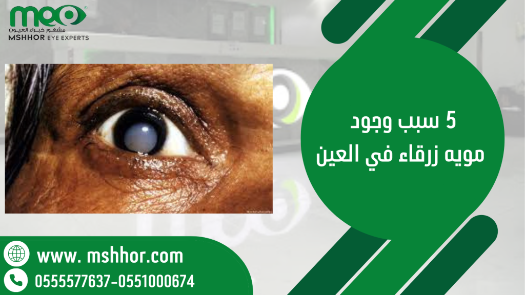 5 سبب وجود مويه زرقاء في العين