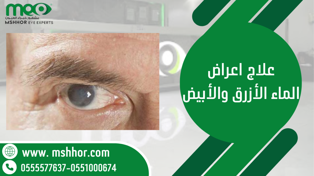 علاج اعراض الماء الأزرق والأبيض