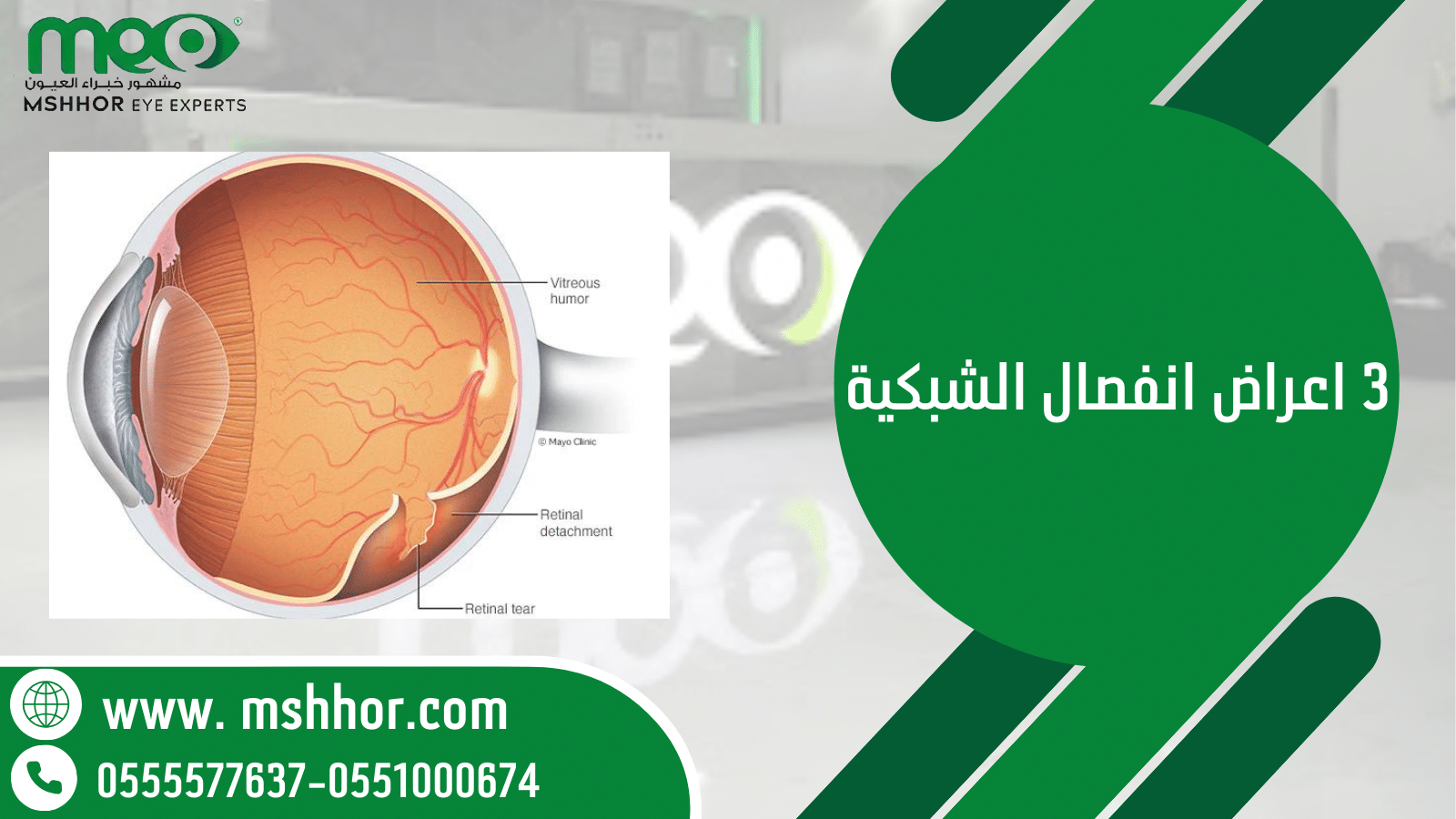 3 اعراض انفصال الشبكية