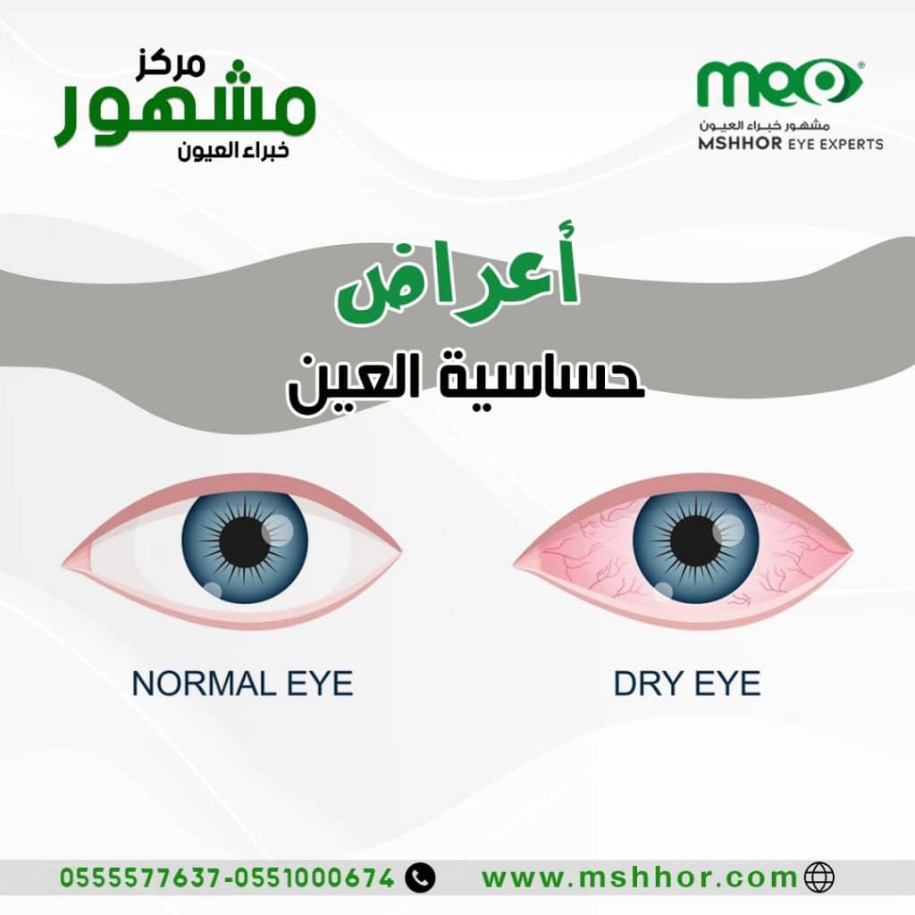 أعراض حساسية العين