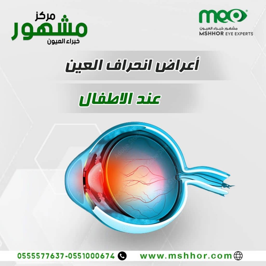 أعراض انحراف العين البسيط عند الأطفال