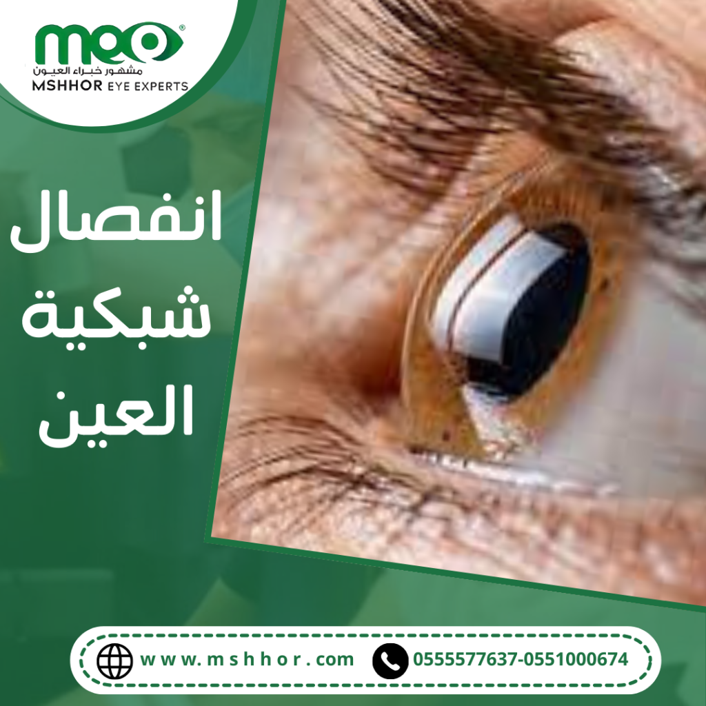 أعراض انفصال شبكية العين