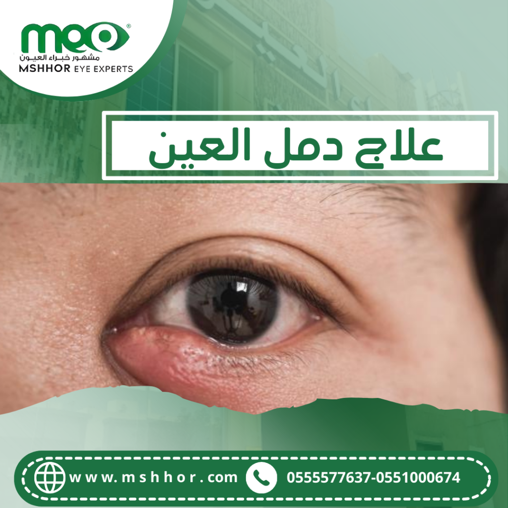 نصائح لعلاج دمل العين