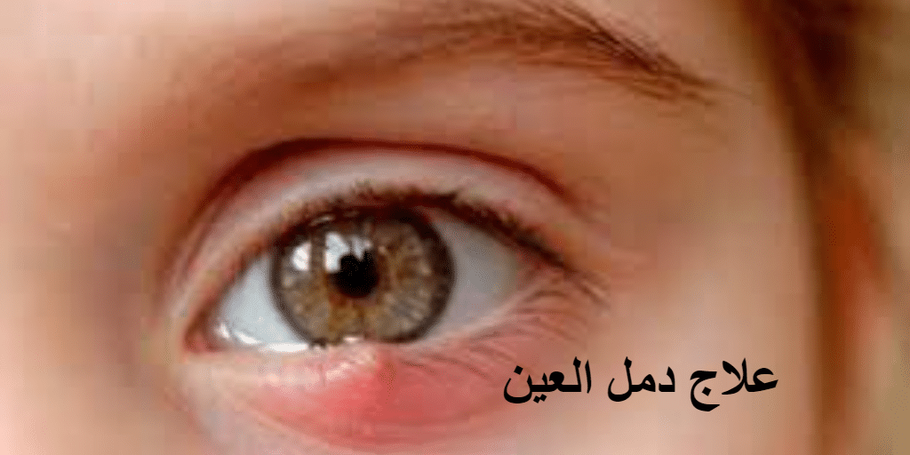 علاج دمل العين