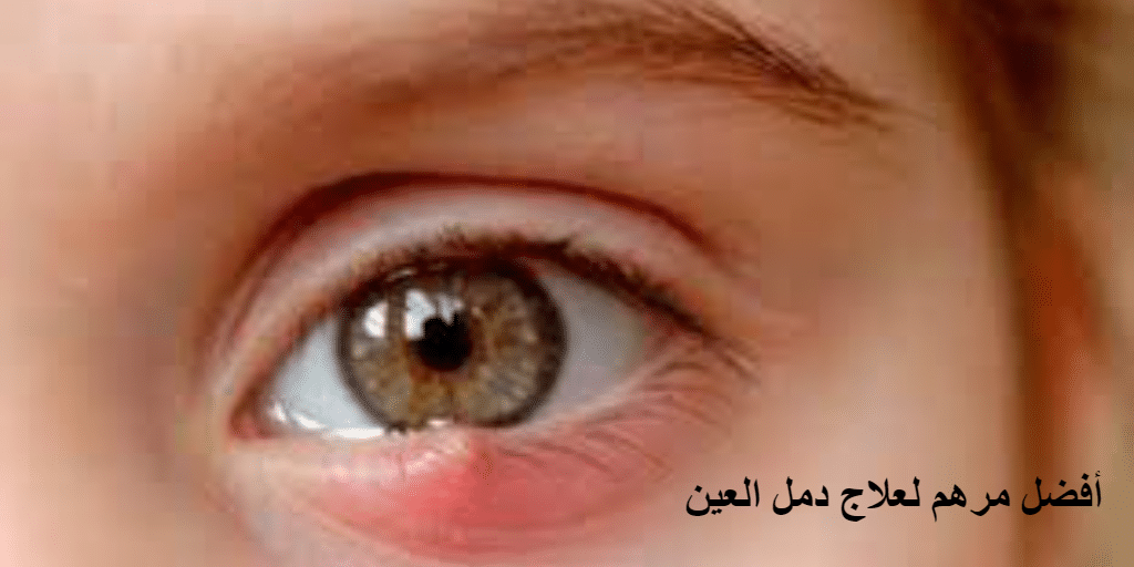 استخدام أفضل مرهم لعلاج دمل العين