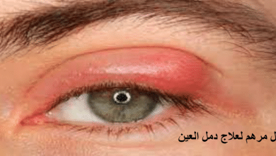استخدام أفضل مرهم لعلاج دمل العين